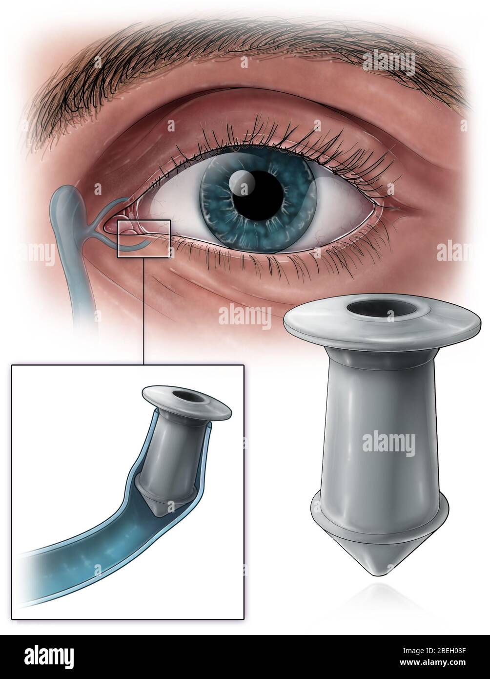 Punctal-Stecker Stockfoto