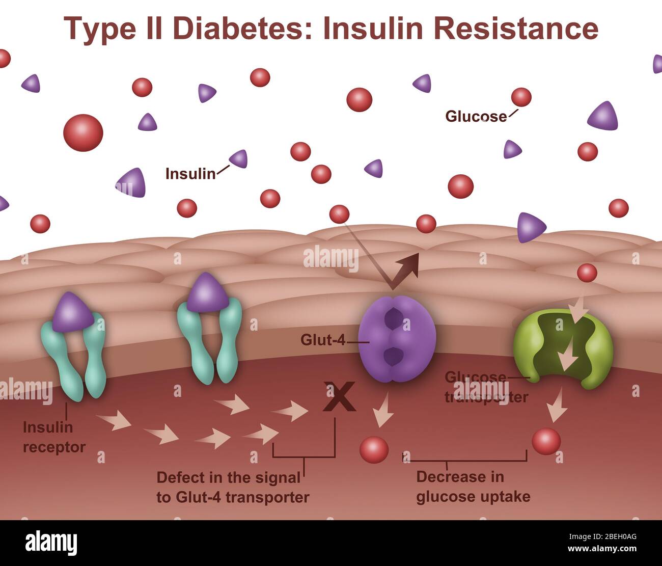 Typ-2-Diabetes Stockfoto