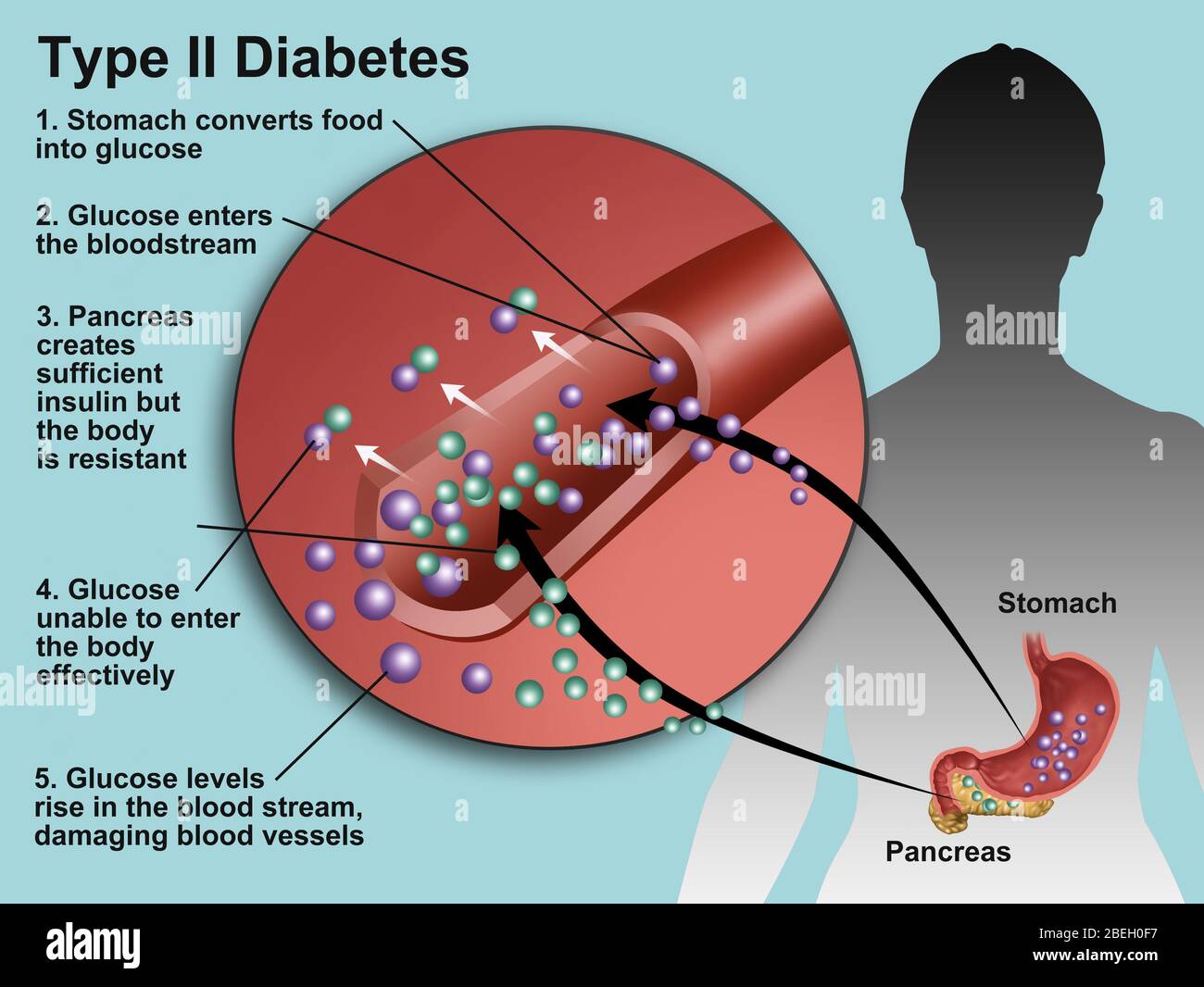 Typ-2-Diabetes Stockfoto