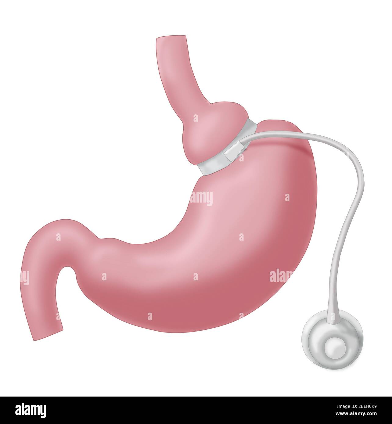 Einstellbare Gastric Band Stockfoto