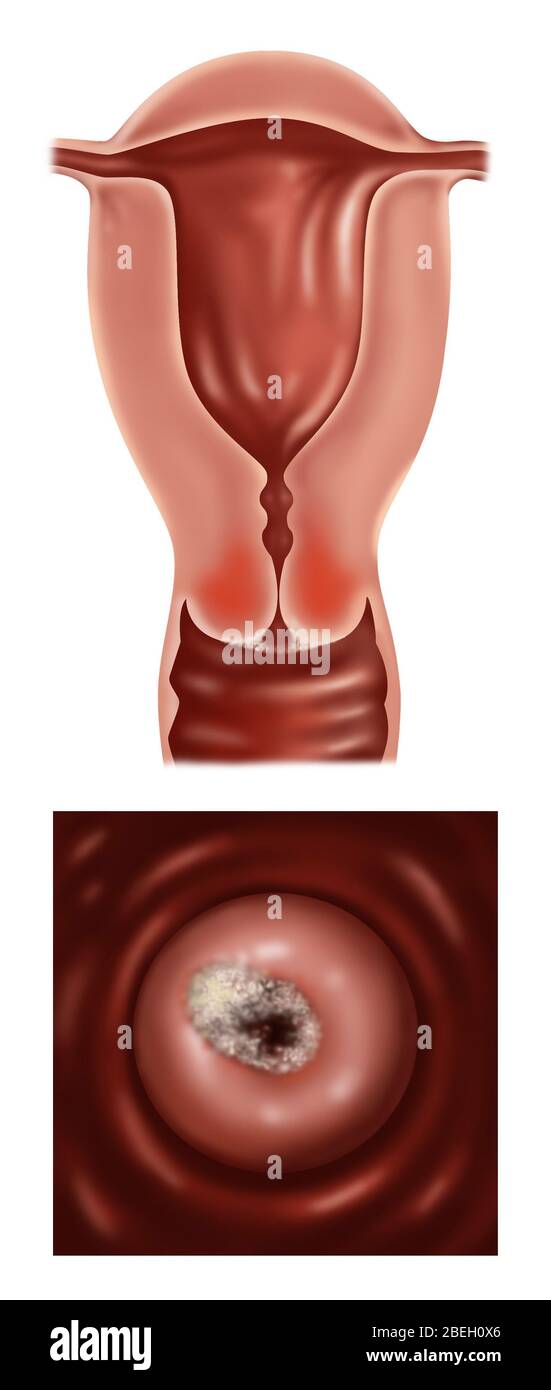 Frühstadium IB von Gebärmutterhalskrebs Stockfoto