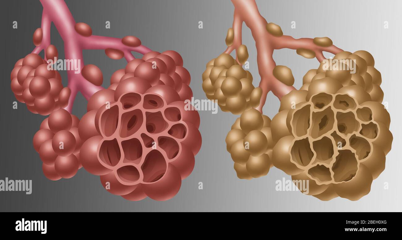Normale vs. Emphysematöse Alveolen Stockfoto
