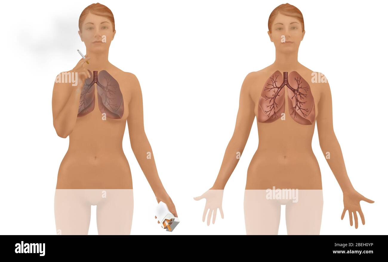Lungen von Raucher vs. Nichtraucher Stockfoto