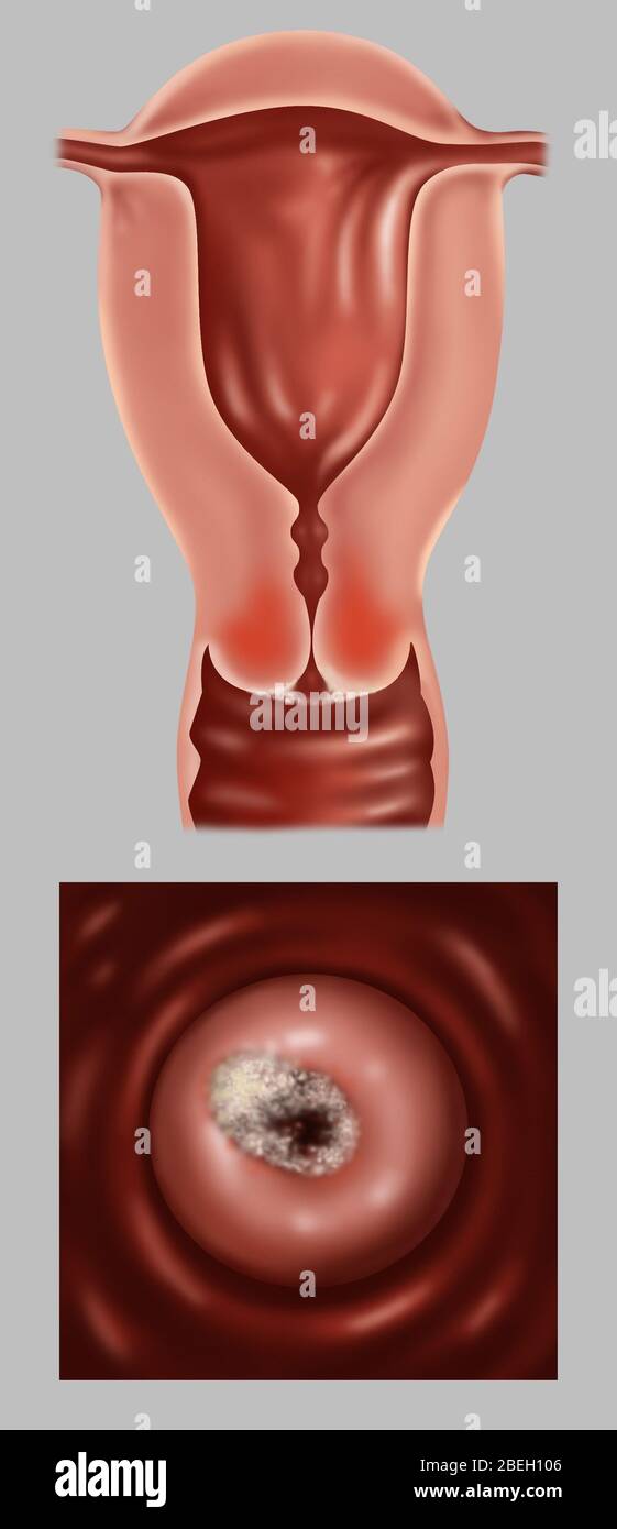 Frühstadium IB von Gebärmutterhalskrebs Stockfoto