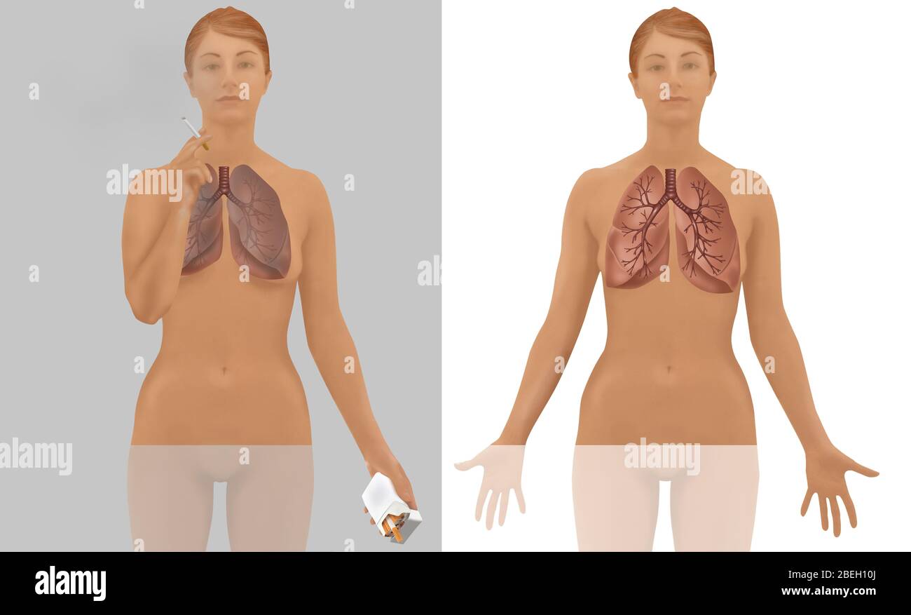 Lungen von Raucher vs. Nichtraucher Stockfoto