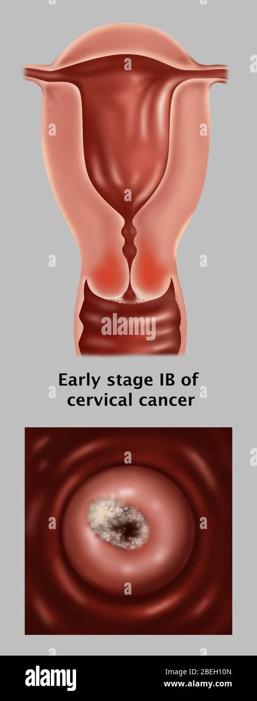 Frühstadium IB von Gebärmutterhalskrebs Stockfoto