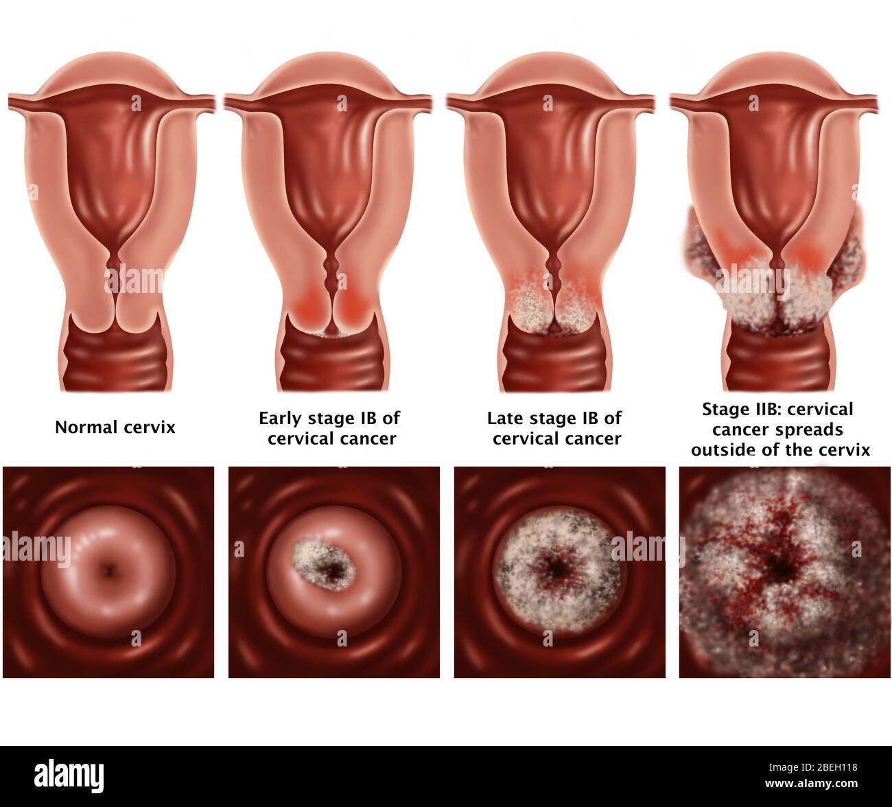 Stadien von Gebärmutterhalskrebs Stockfoto
