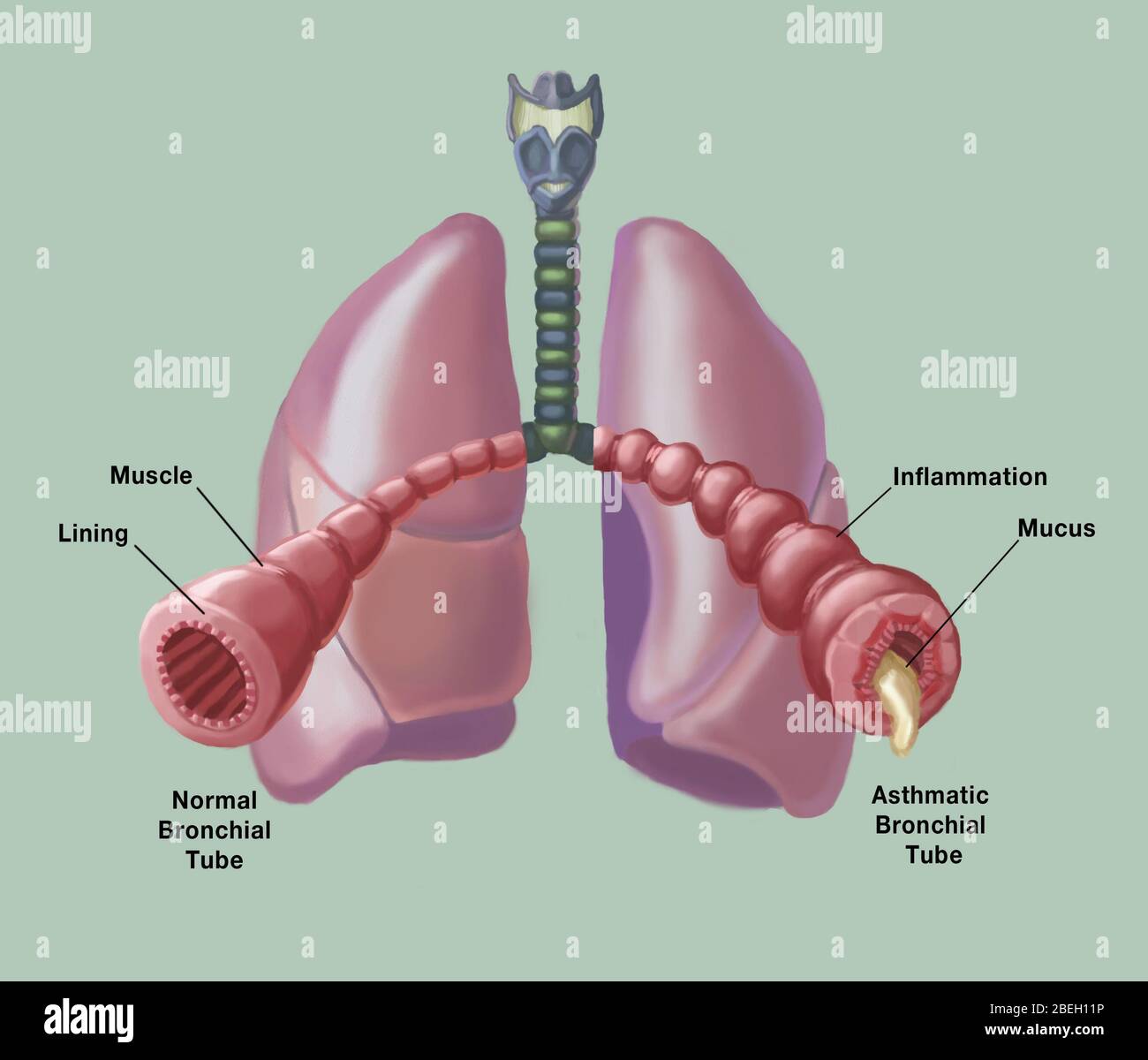 Normale vs. Asthmatische Bronchien Stockfoto
