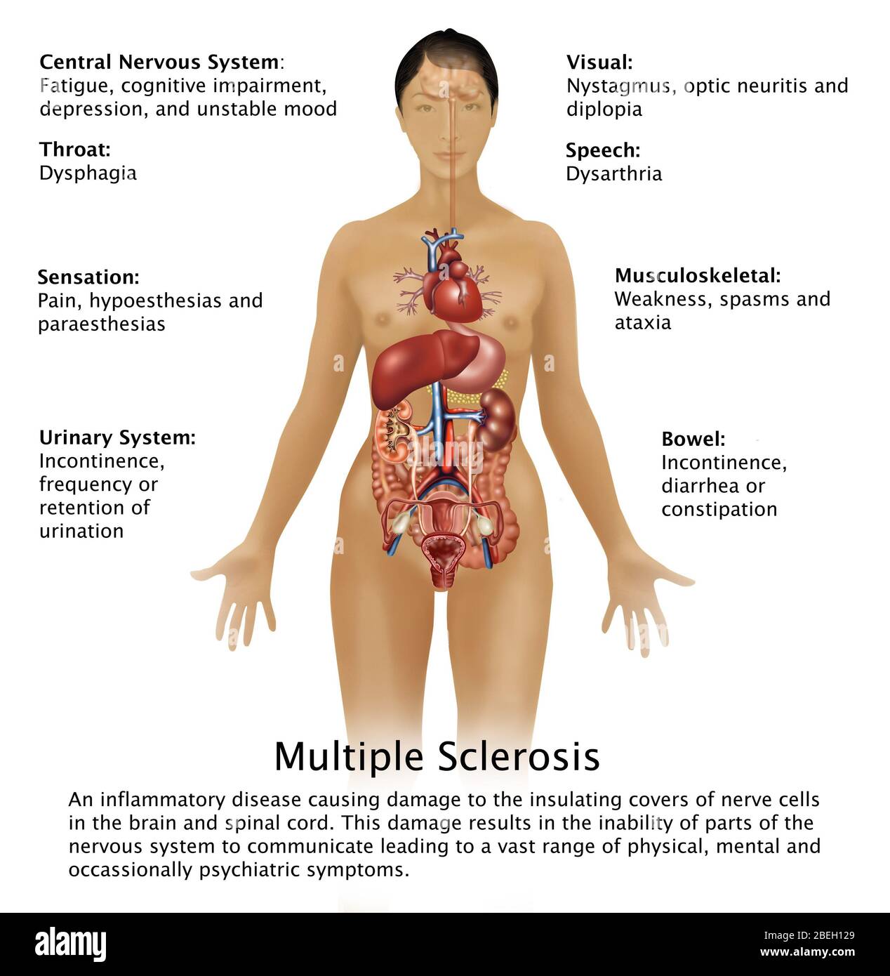 Symptome einer Multiplen Sklerose Stockfoto