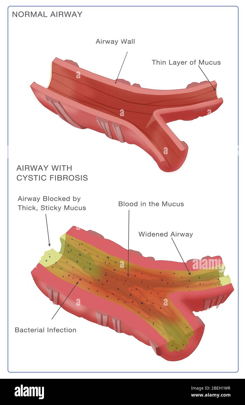 Zystische Fibrose Stockfoto