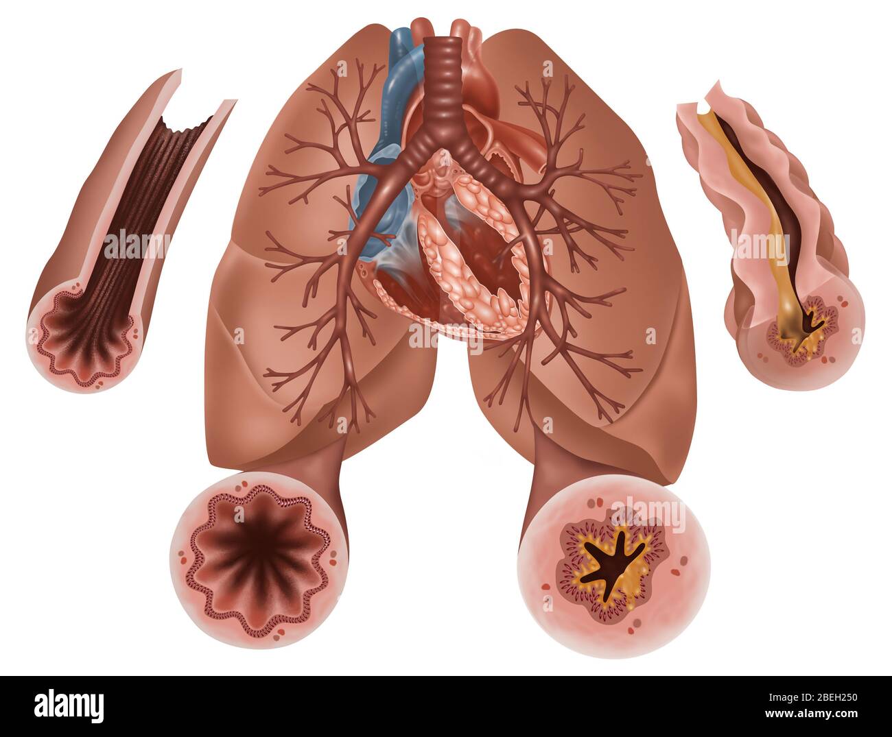 Asthma-Pathologie Stockfoto