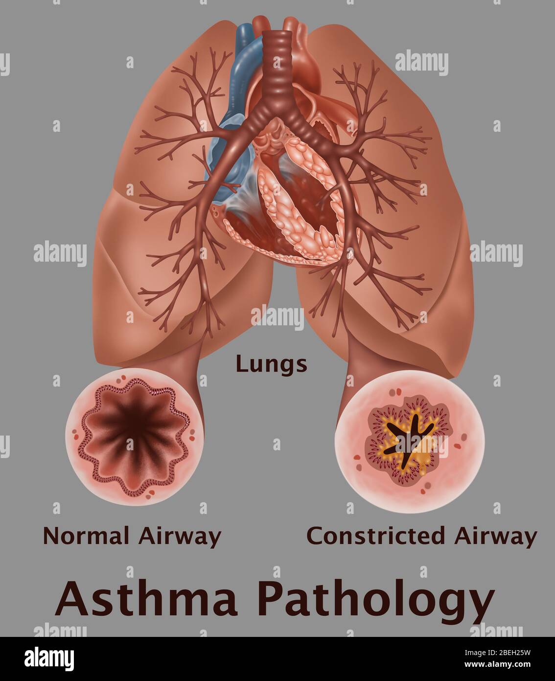 Asthma-Pathologie Stockfoto