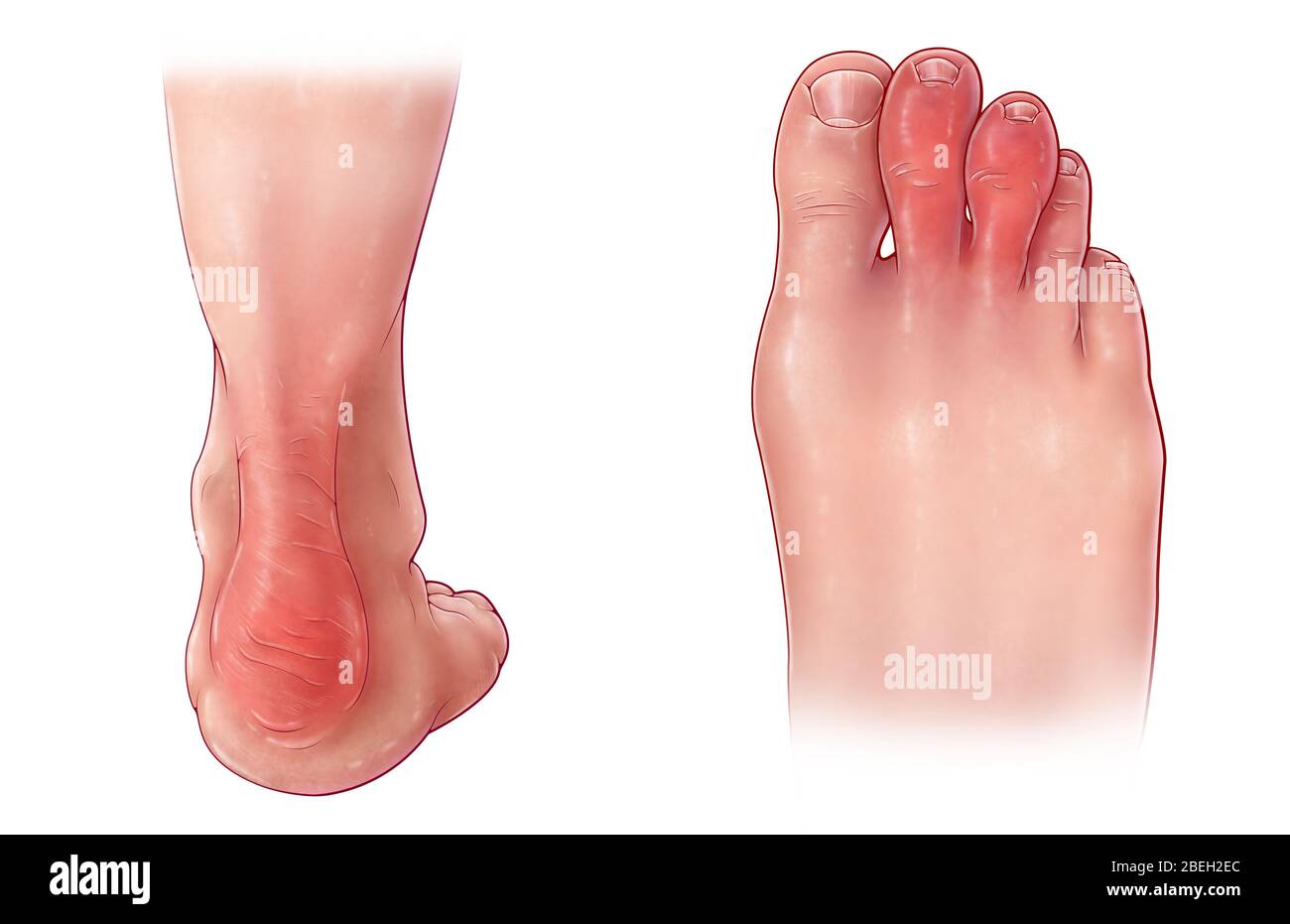 Symptome Der Psoriatischen Arthritis Stockfoto