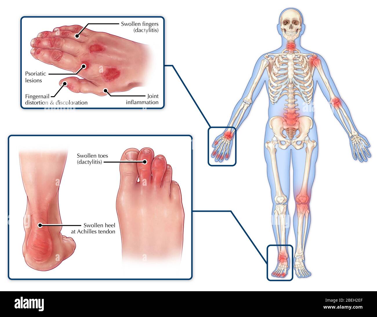 Symptome Der Psoriatischen Arthritis Stockfoto