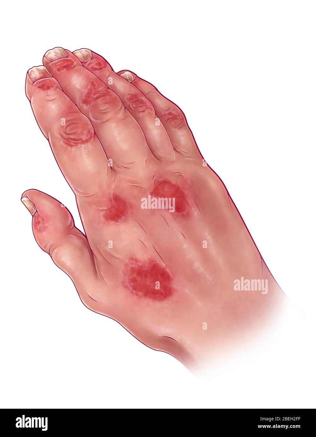 Psoriasis-Arthritis Stockfoto