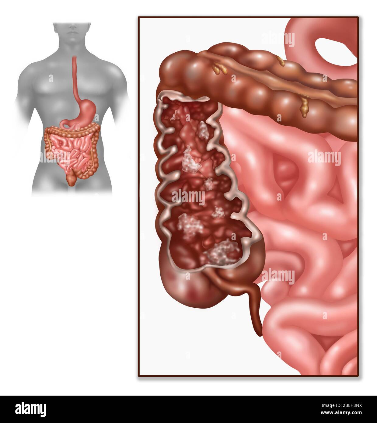 Morbus Crohn, IBD, Illustration Stockfoto