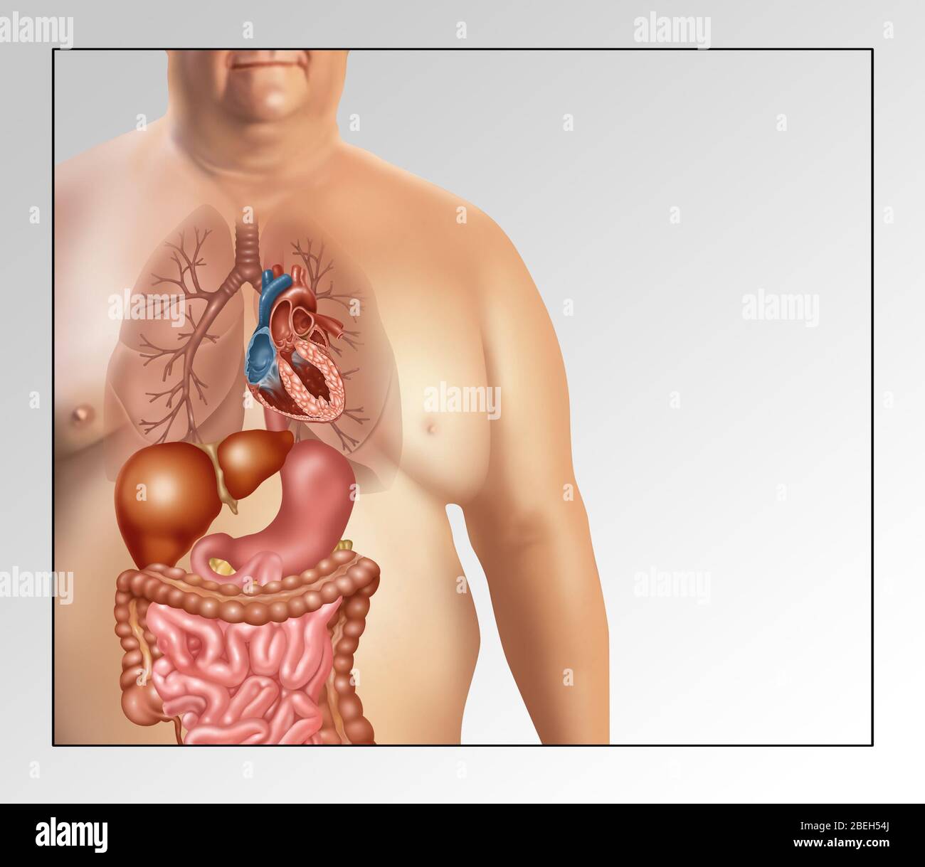 Gefahren der Adipositas, Illustration Stockfoto