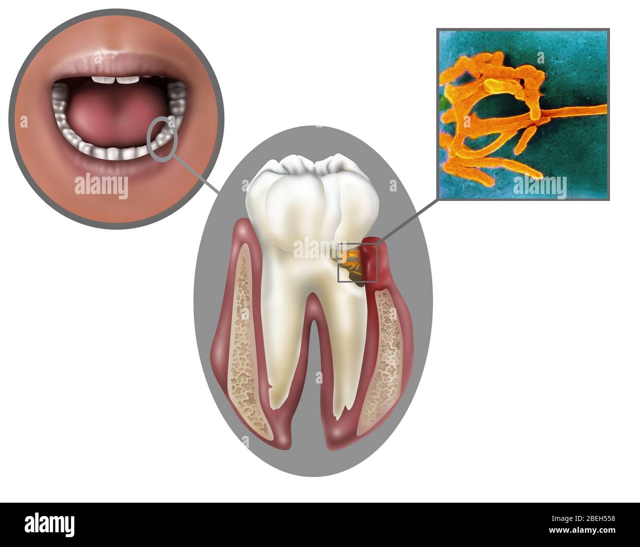 Orale Infektion von Fusobacterium nucleatum Stockfoto