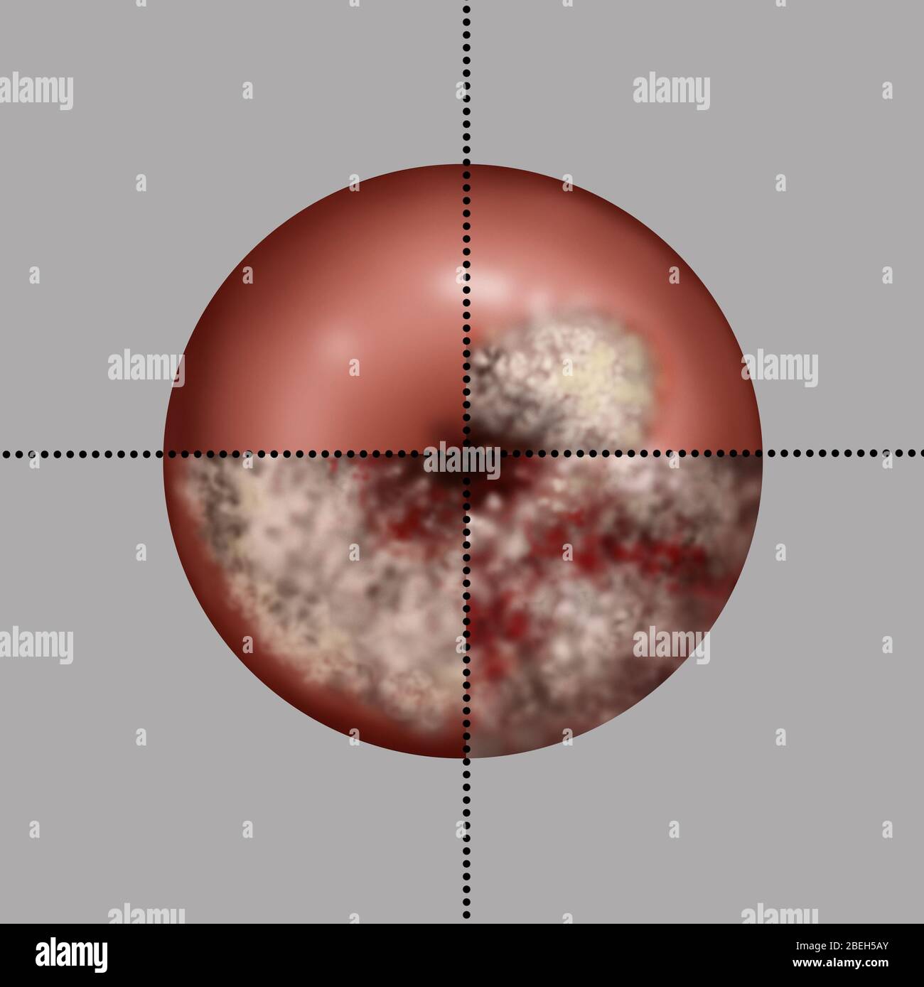 Halswirbelkrebs Progression, Illustration Stockfoto