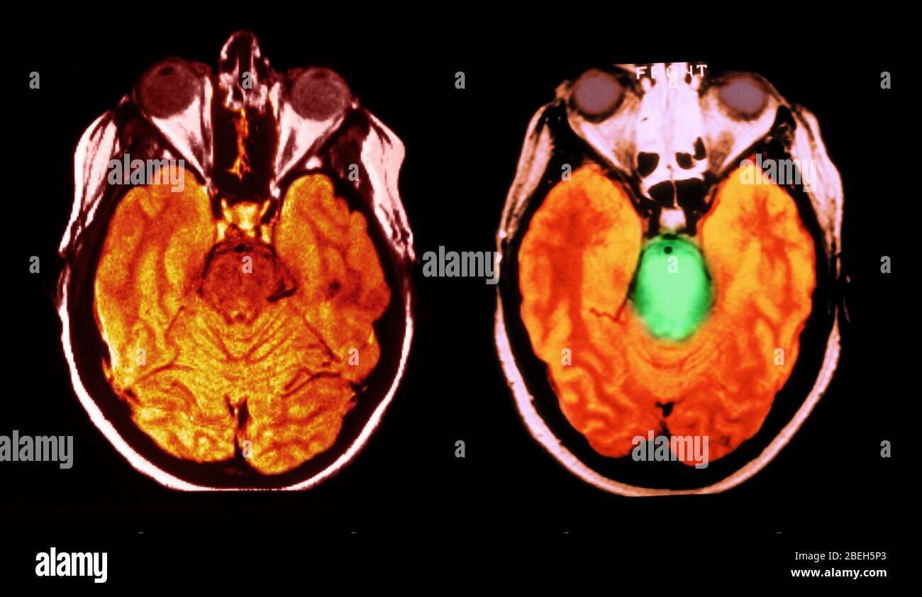 MRT des normalen Gehirns und Hirnstammglioms Stockfoto