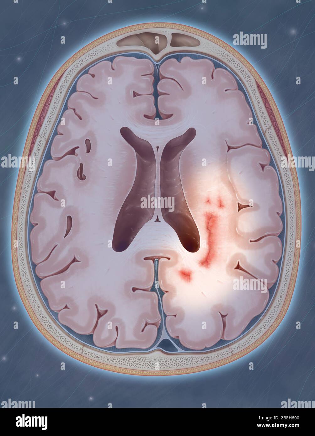 Multiple Sklerose Stockfoto