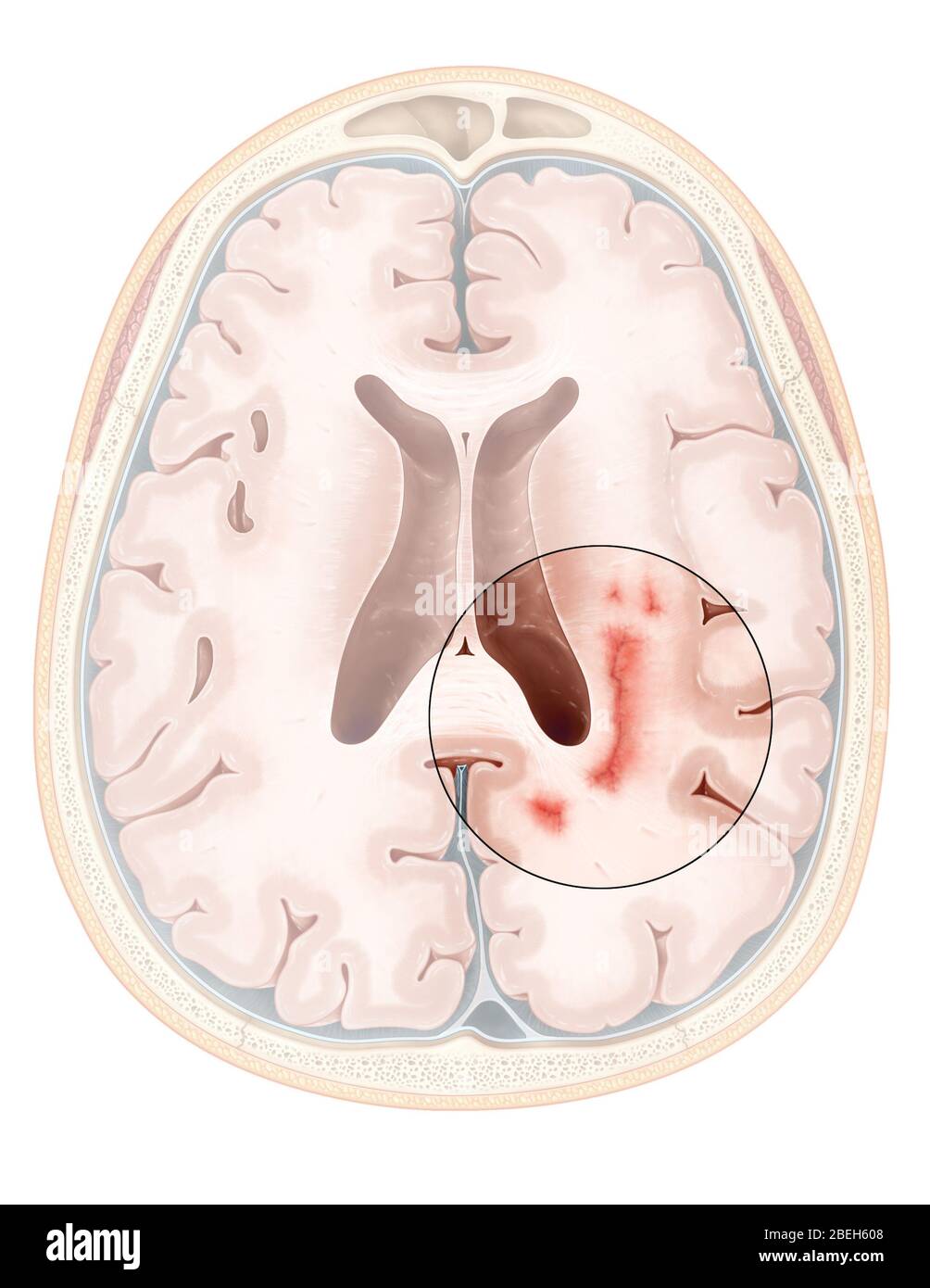 Multiple Sklerose Stockfoto