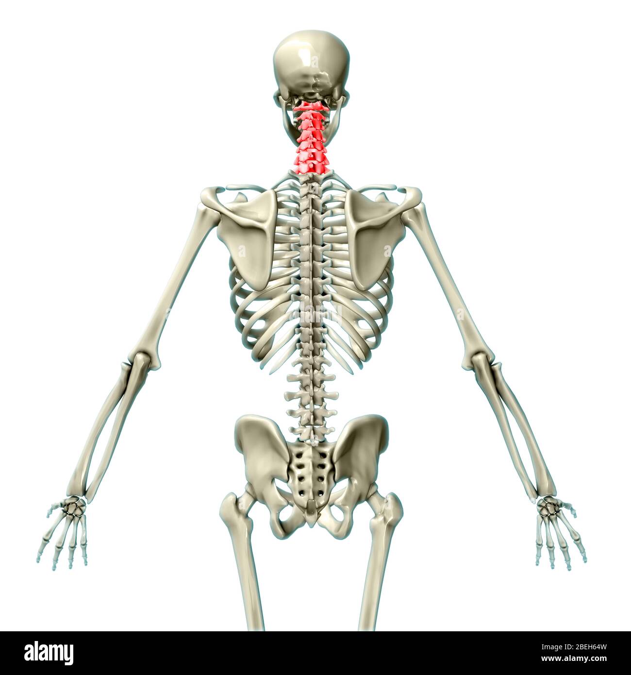 Nackenstütze an der Prothese. Bruch der Halswirbel. Behandlung von