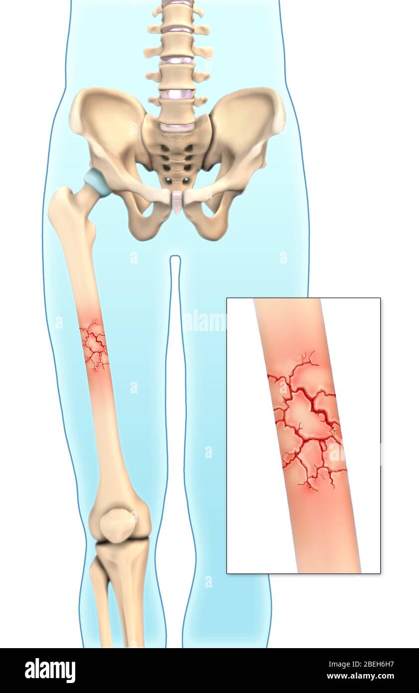 Knochenbruch In Minuten, Illustration Stockfoto