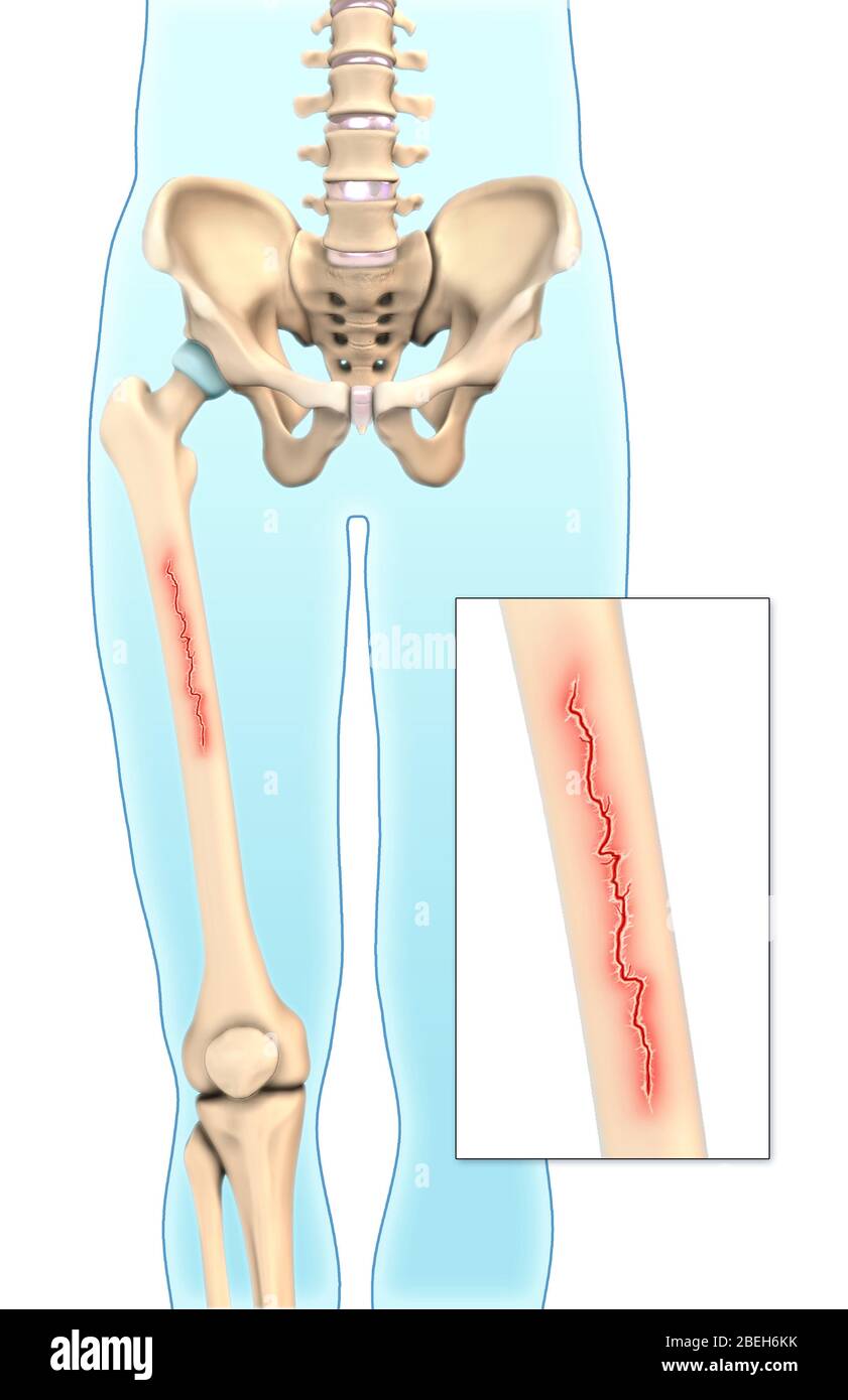 Eine Illustration eines linearen Bruchs, bei dem entlang der langen Achse des Knochens ein Bruch auftritt. Stockfoto