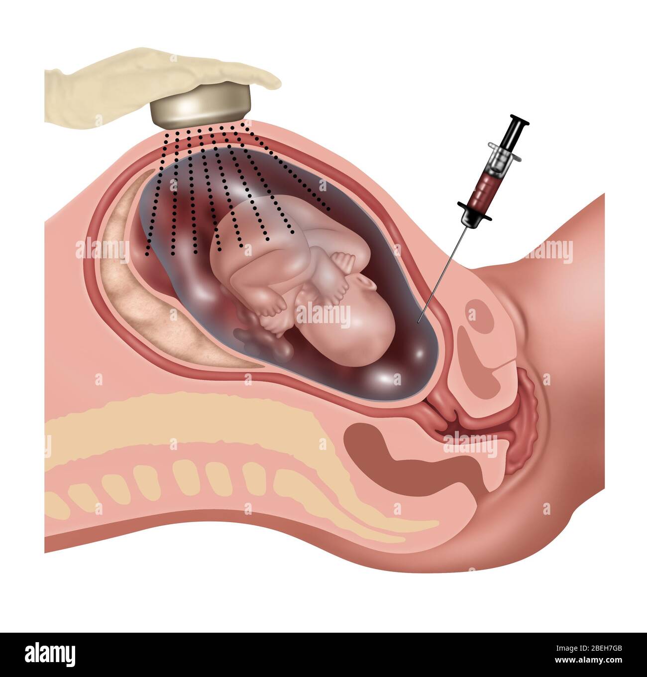 Amniozentese, Abbildung Stockfoto