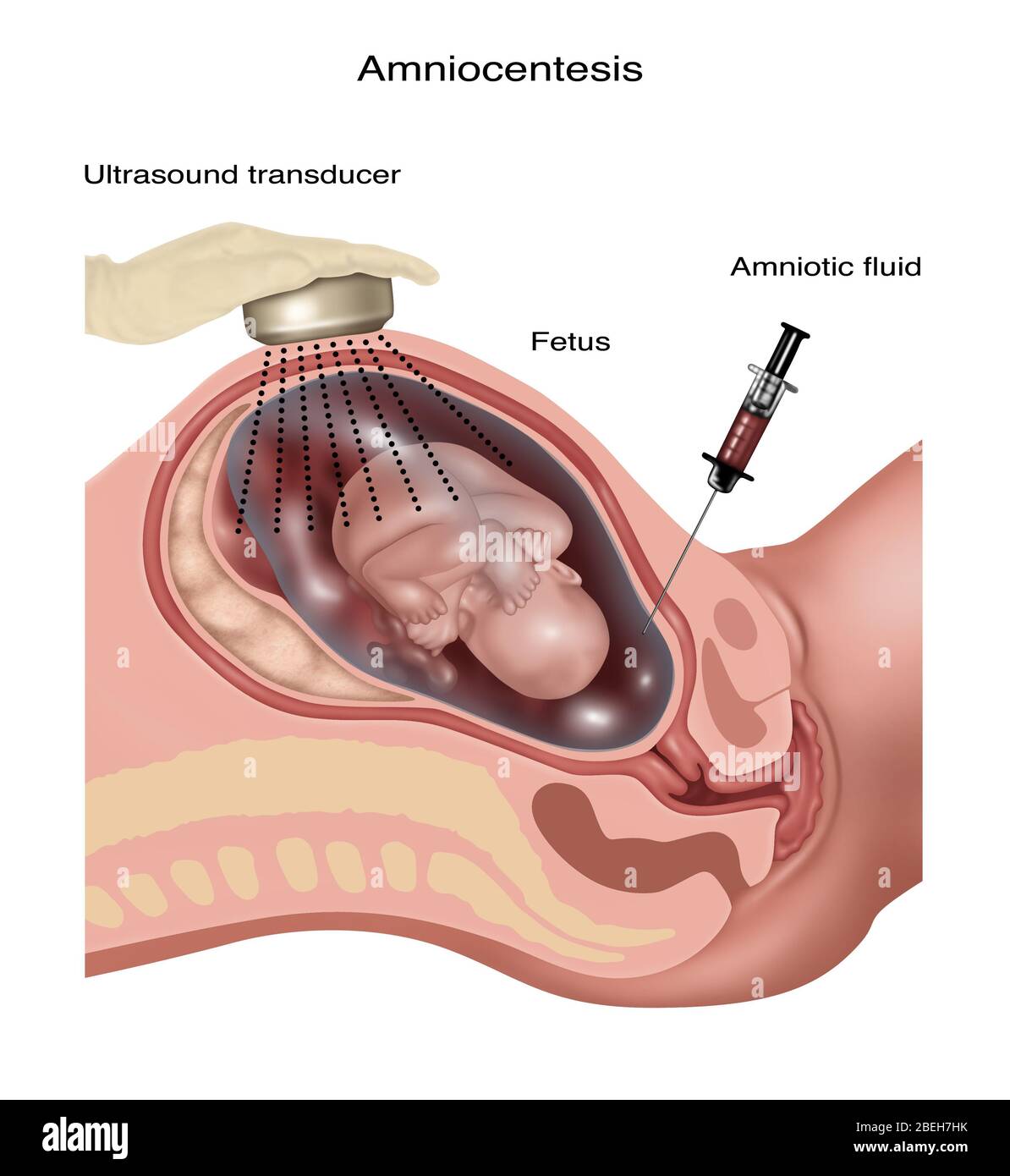 Amniozentese, Abbildung Stockfoto