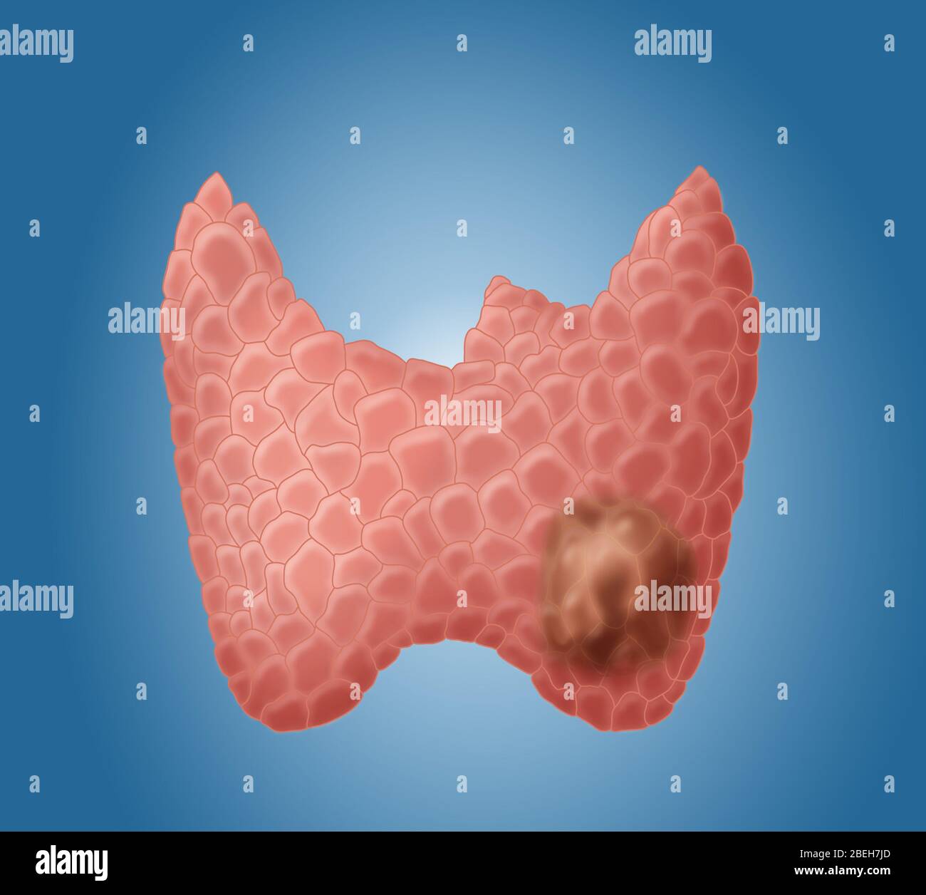 Schilddrüsen-Krebs Stockfoto