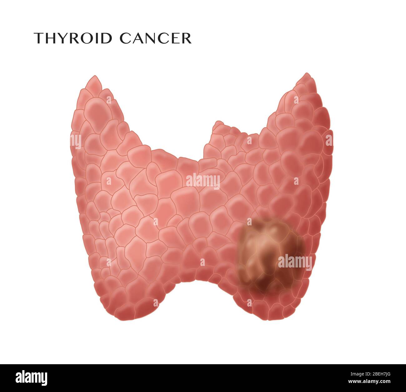 Schilddrüsen-Krebs Stockfoto