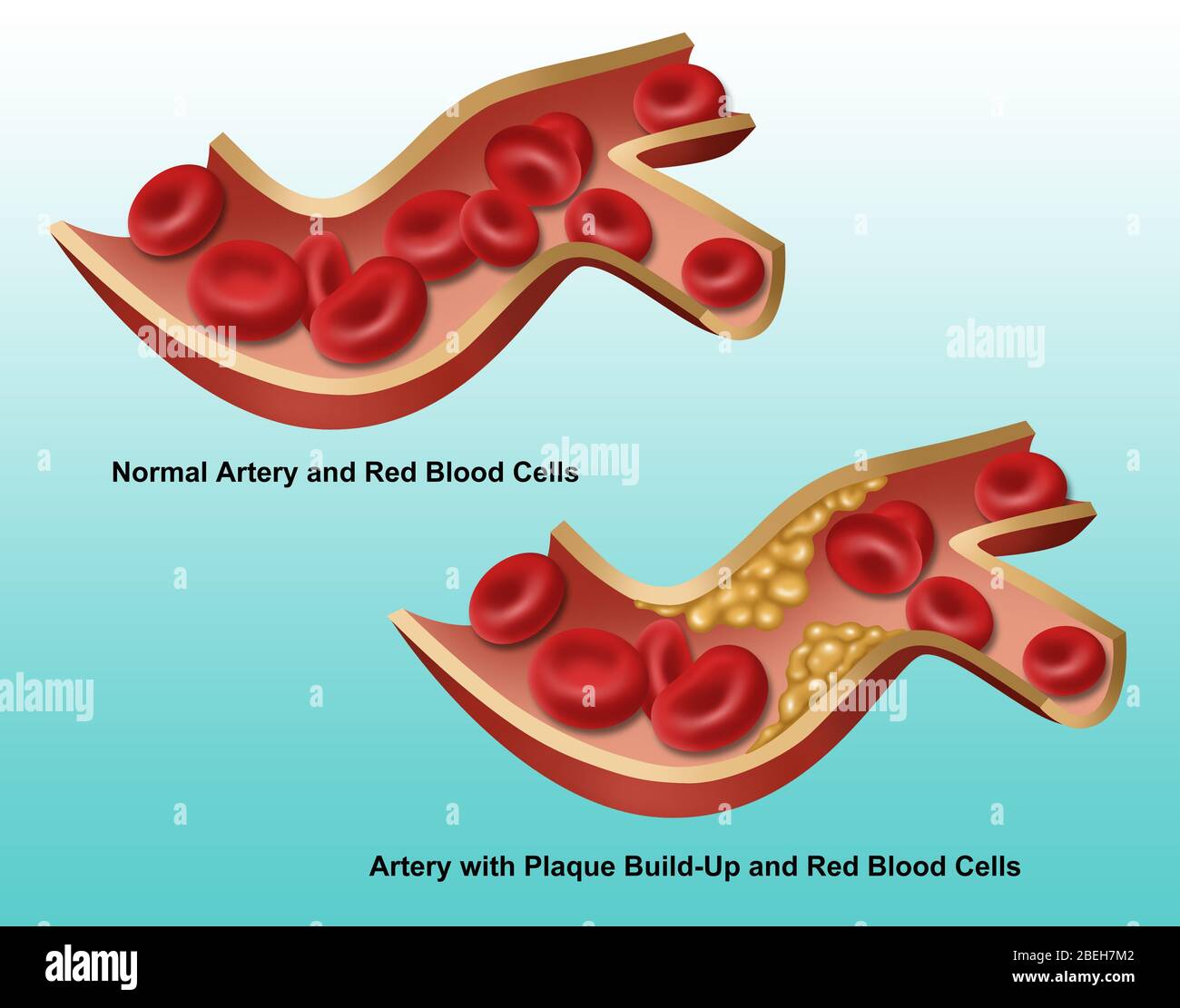 Arterie, Normal vs. Gehärtet, Illustration Stockfoto