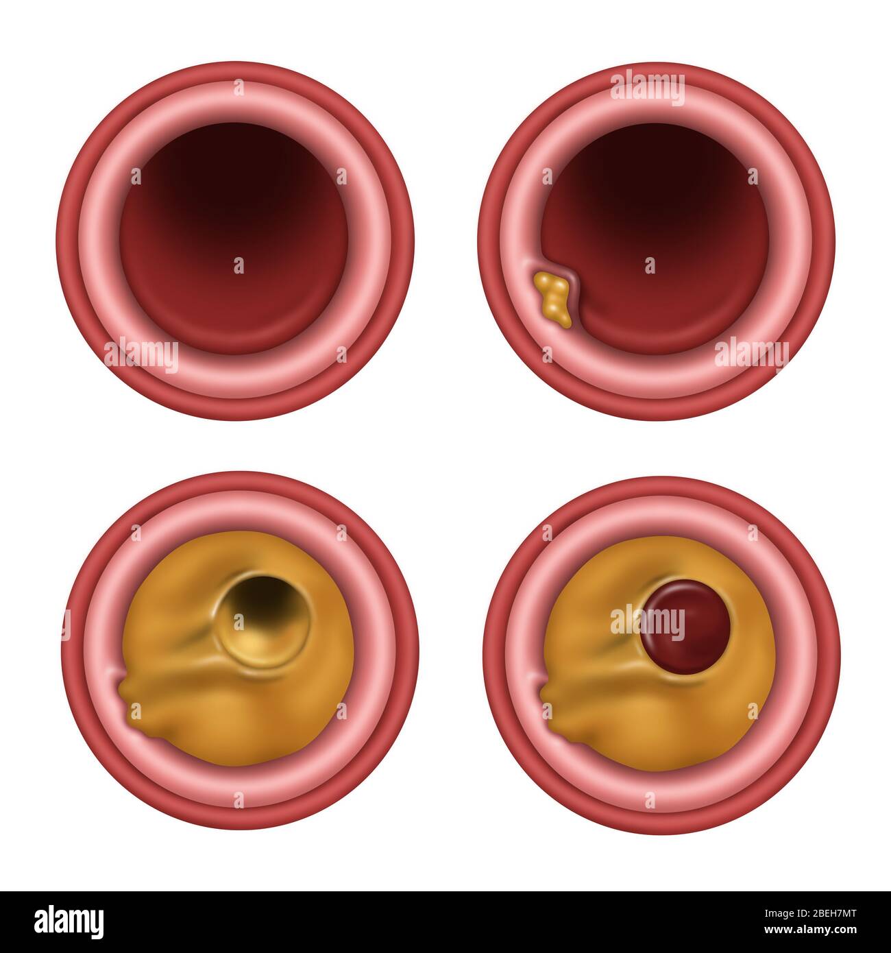 Verstopfte Arterie, Abbildung Stockfoto