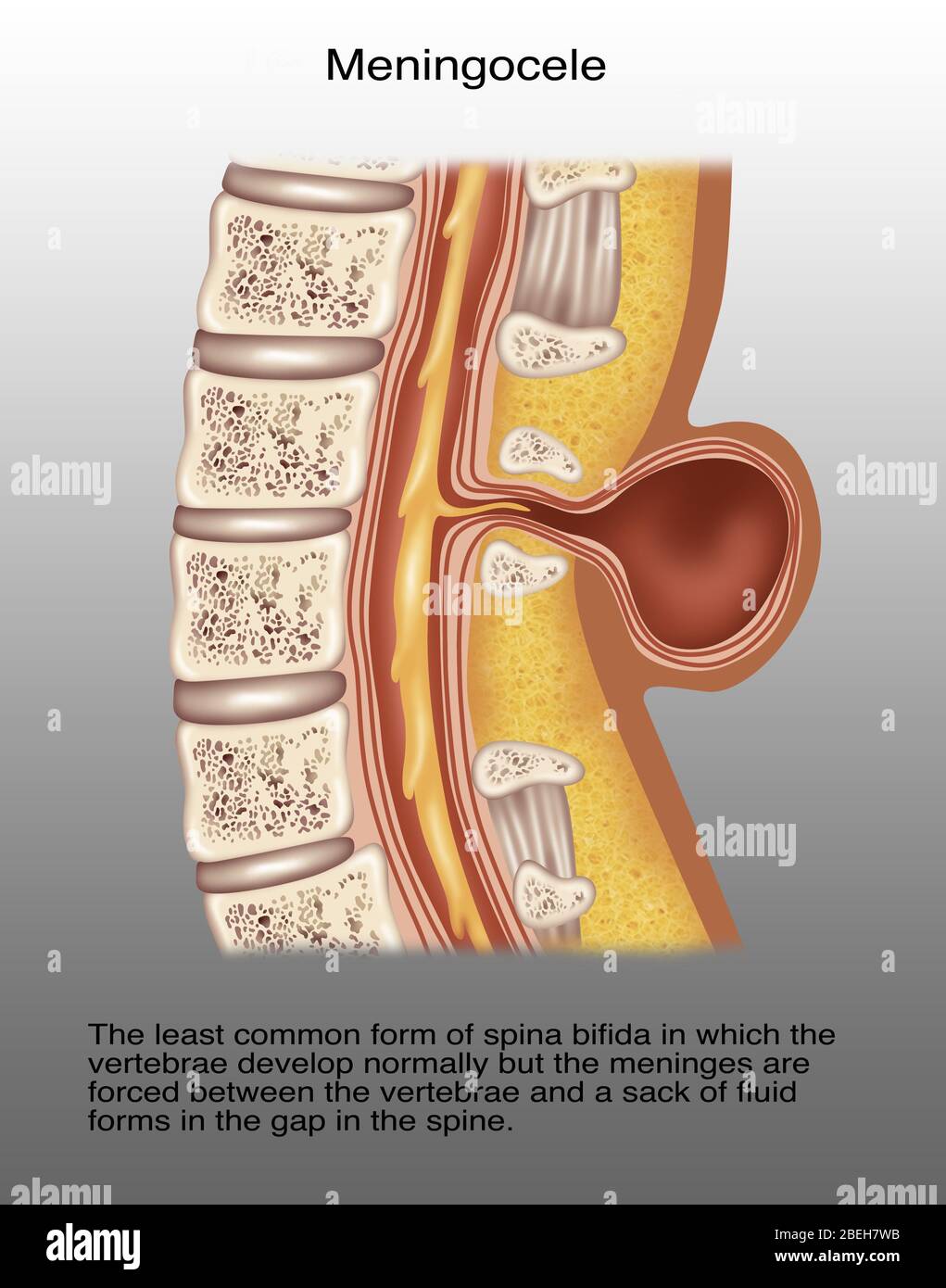 Spina Meningocele, Illustration Stockfotografie - Alamy