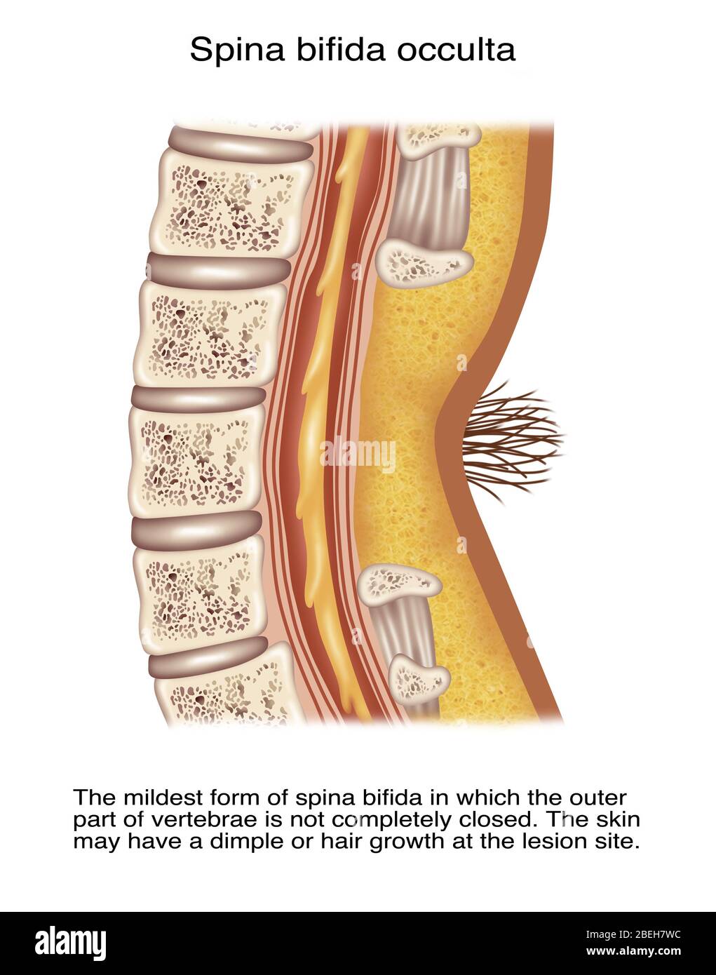 Spina Bifida Occulta, Illustration Stockfoto