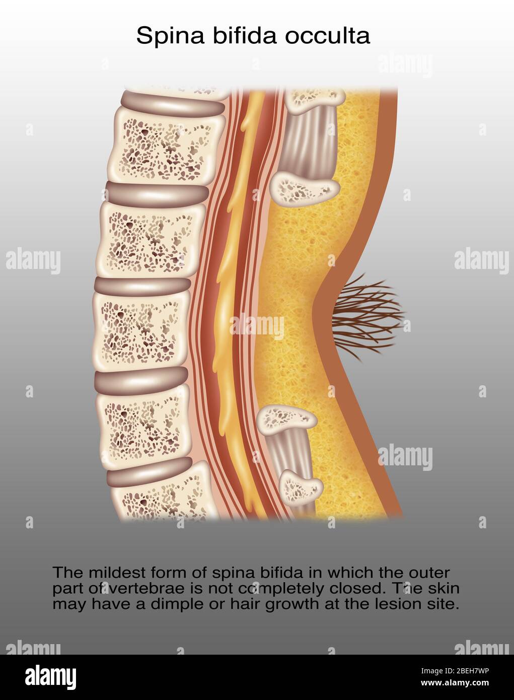 Spina Bifida Occulta Stockfotos und bilder Kaufen Alamy
