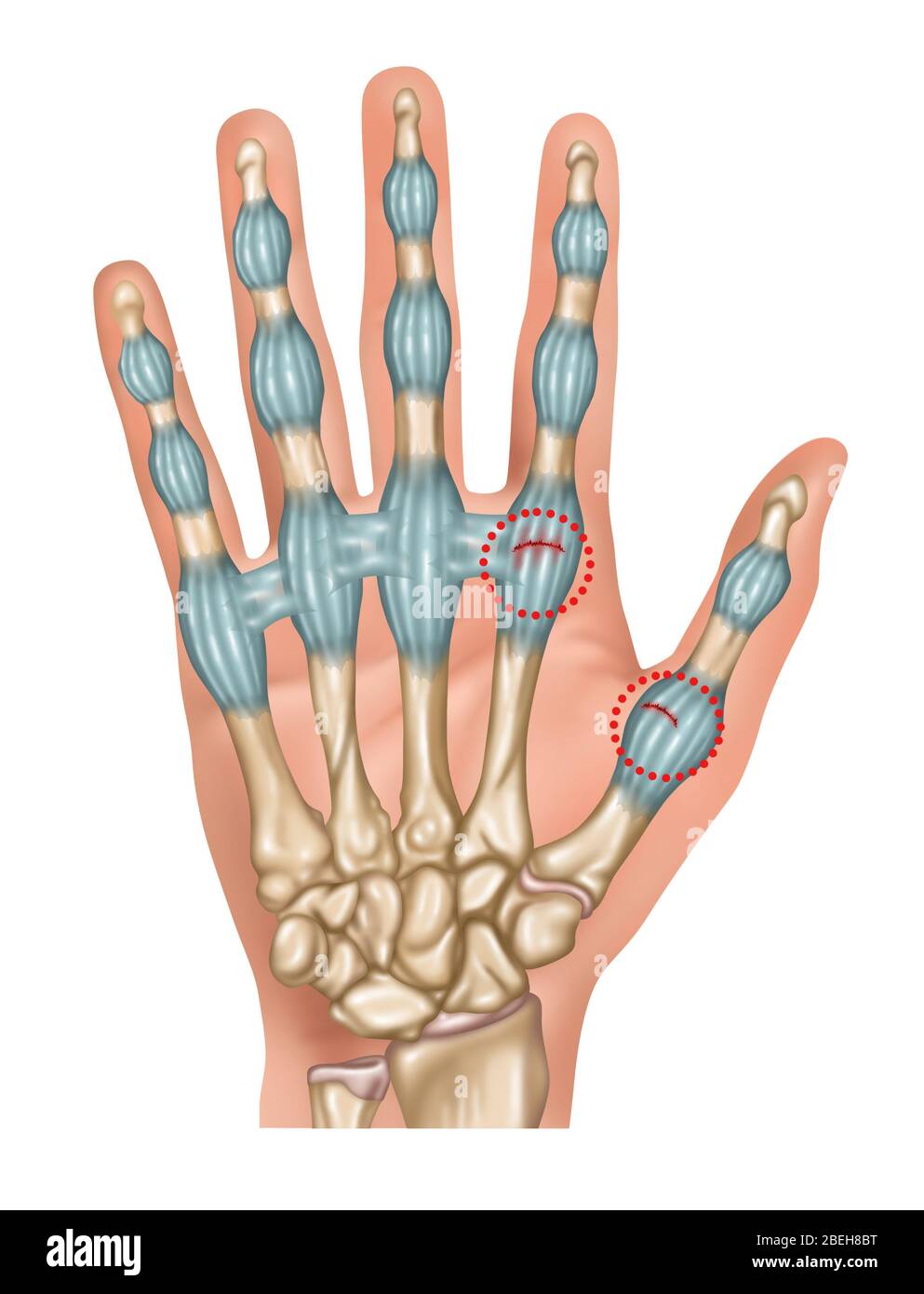 Verstauchte Finger Und Daumen, Illustration Stockfoto Verstauchte Finger Und Daumen, Illustration Stockfoto