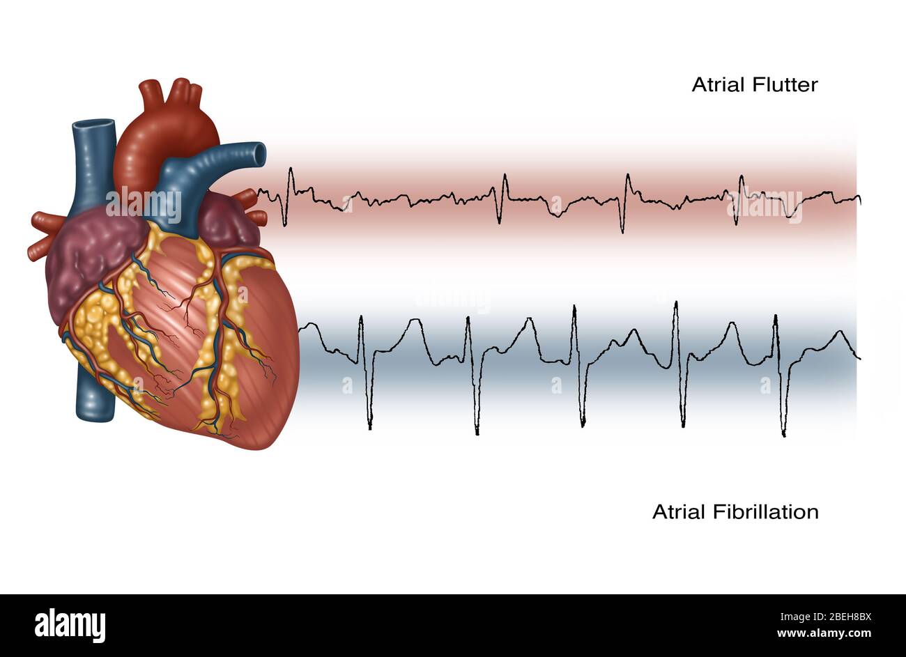 Illustration von unregelmäßigen Herzschlägen Stockfoto