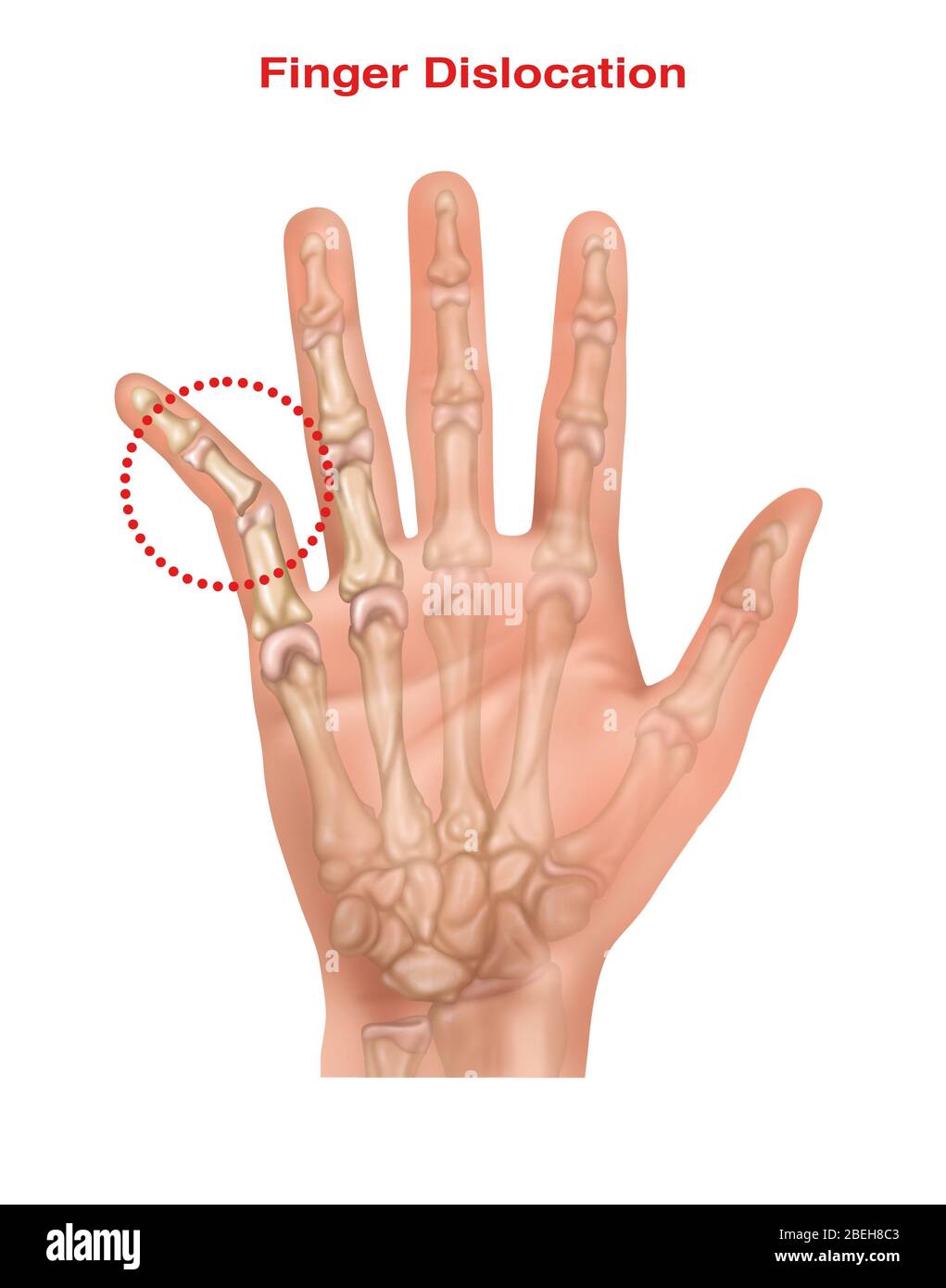 Dislocated Pinky, Illustration Stockfoto
