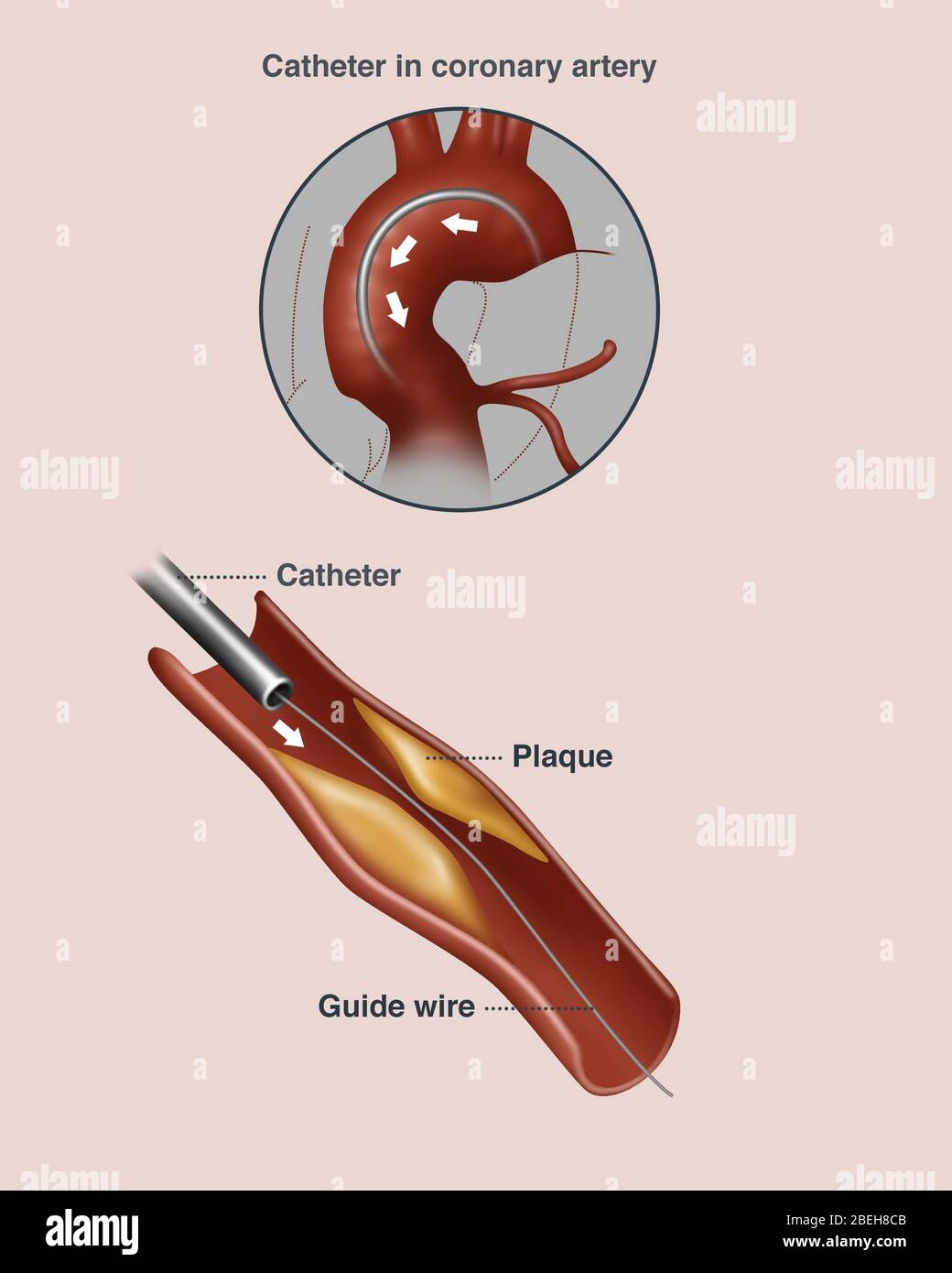 Fett Aufbau in Arterie, Illustration Stockfoto