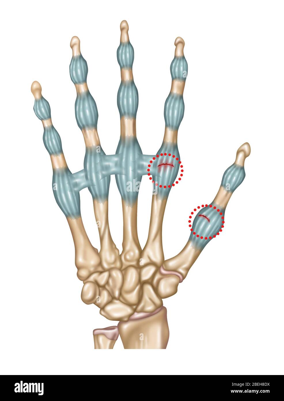 Verstauchte Finger Und Daumen, Illustration Stockfoto Verstauchte Finger Und Daumen, Illustration Stockfoto