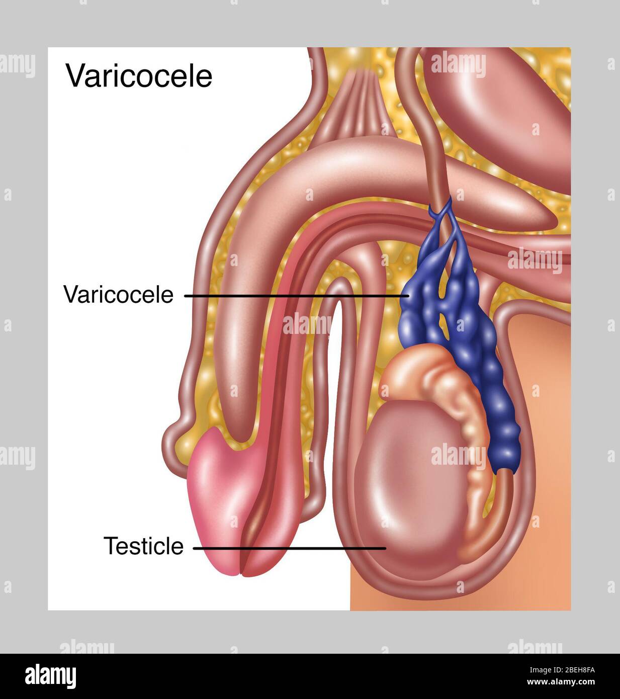 Skrotalvarikozele, Illustration Stockfoto