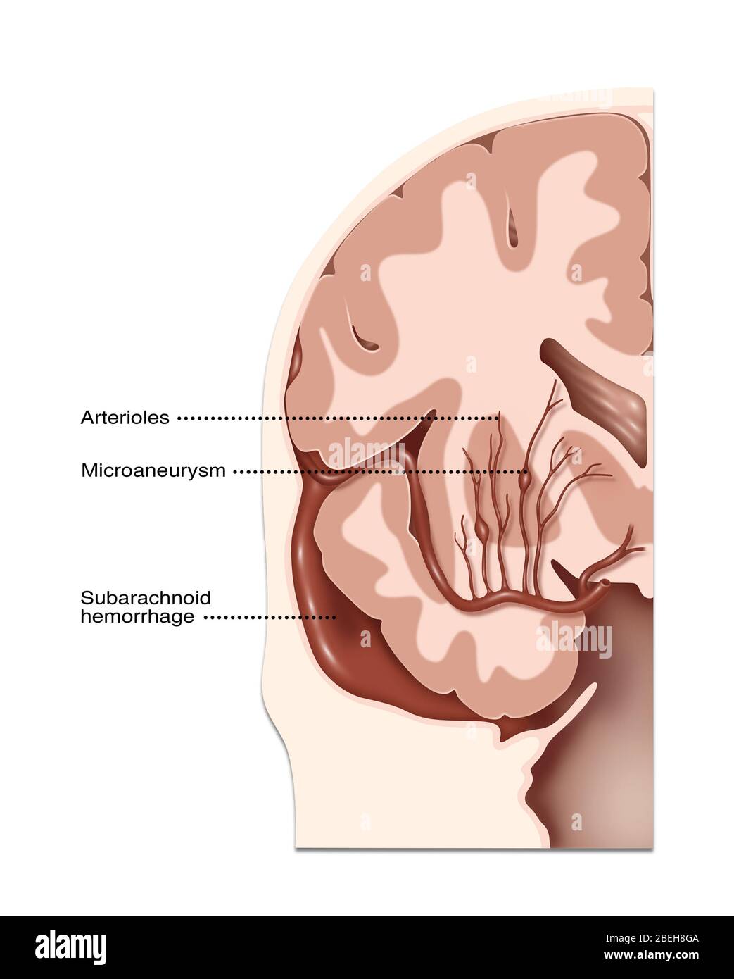 Hämorrhagische Schlaganfallorte, Illustration Stockfoto