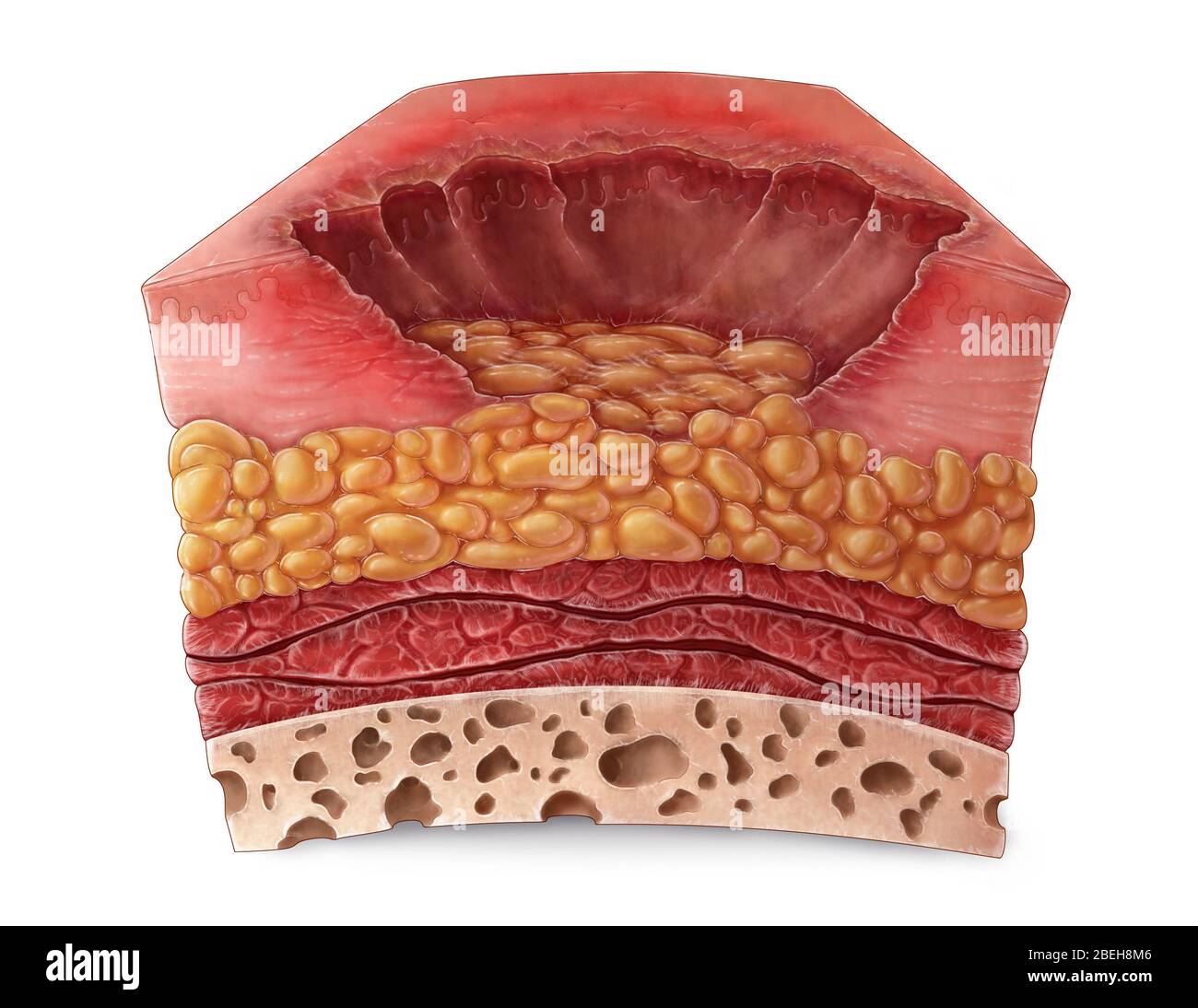 Verbrennung dritten Grades Stockfotografie - Alamy