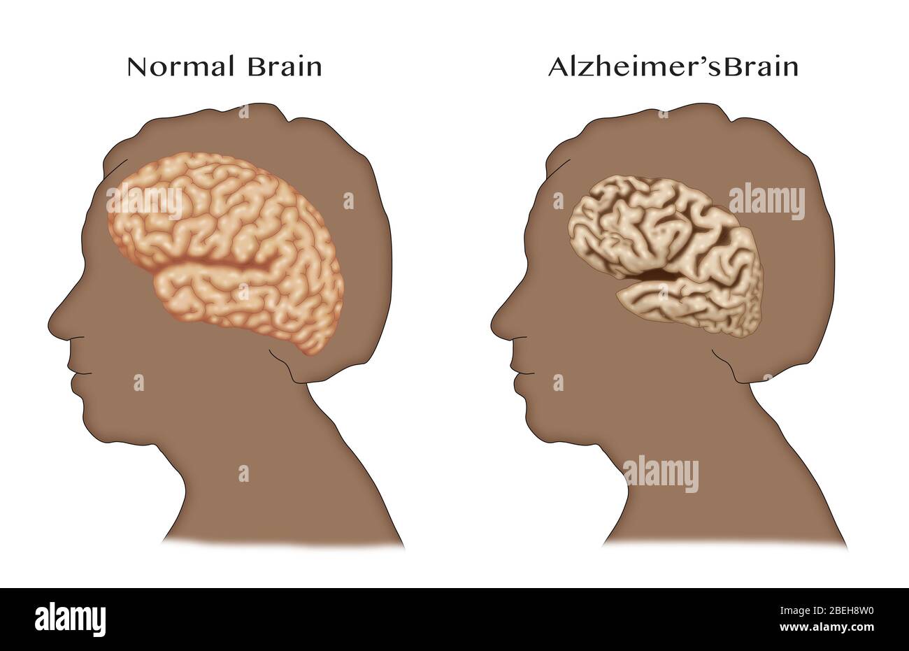Alzheimer und normale Gehirne, Vergleich Stockfoto