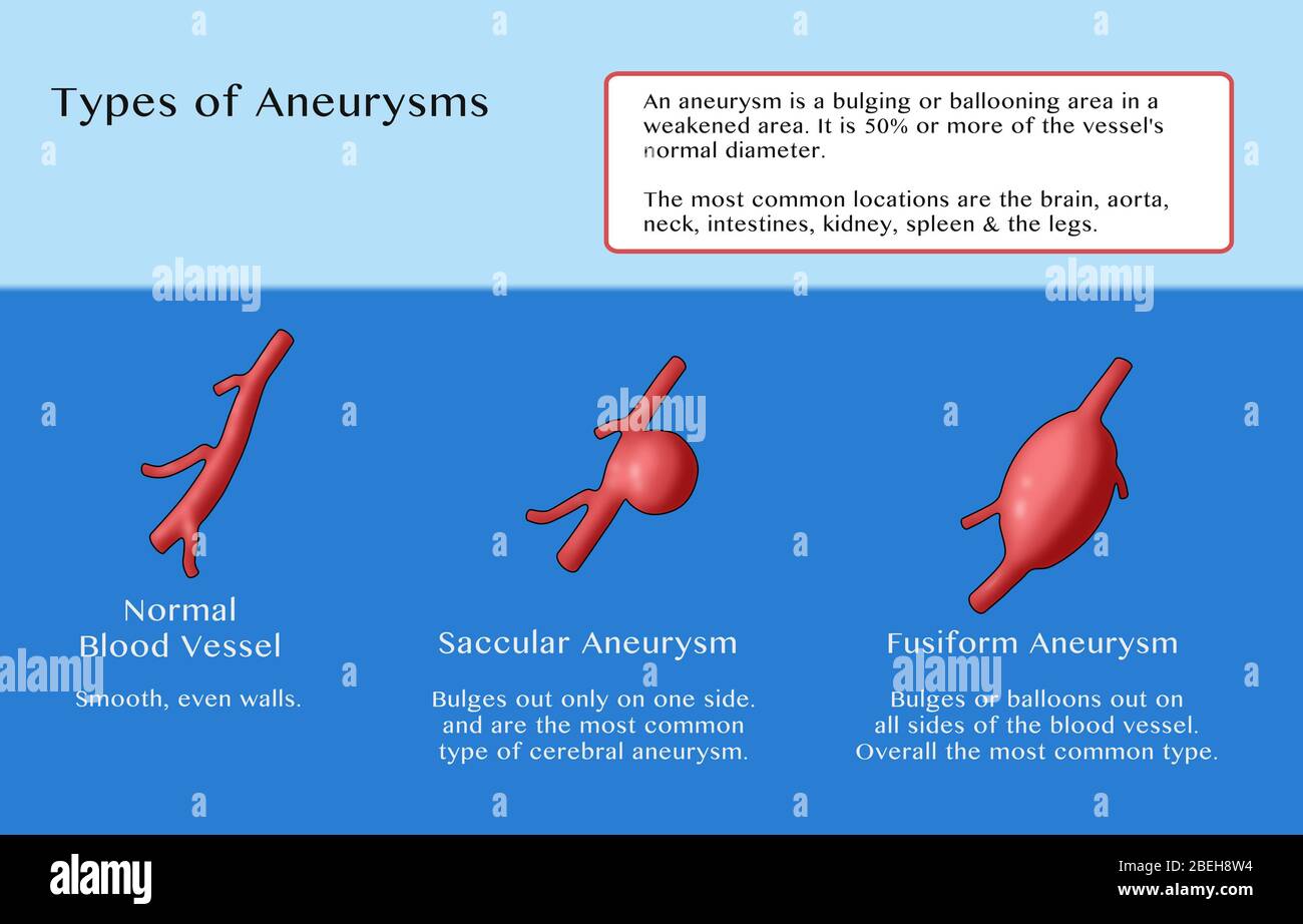 Infografik zum Vergleich eines normalen Blutgefäßes (links) mit zwei Aneurysmarten: Einem sakkulären Aneurysma (Mitte), der am häufigsten vorkommende Typ des zerebralen Aneurysmas, bei dem das Blutgefäß nur auf einer Seite auswölbt; Und ein fusiforme Aneurysma (rechts), die häufigste allgemeine Art, wo das Blutgefäß auswölbt auf allen Seiten. Stockfoto