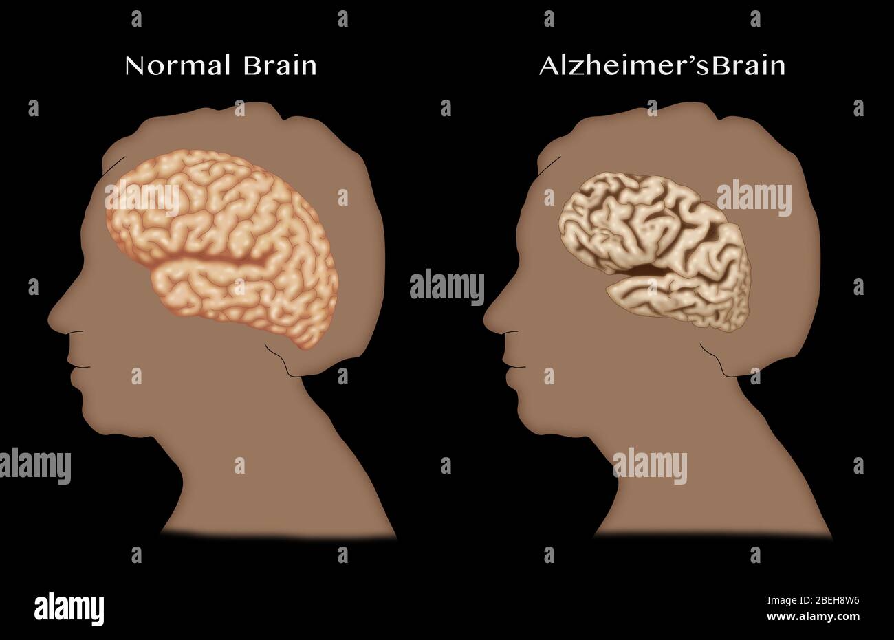 Alzheimer und normale Gehirne, Vergleich Stockfotografie - Alamy