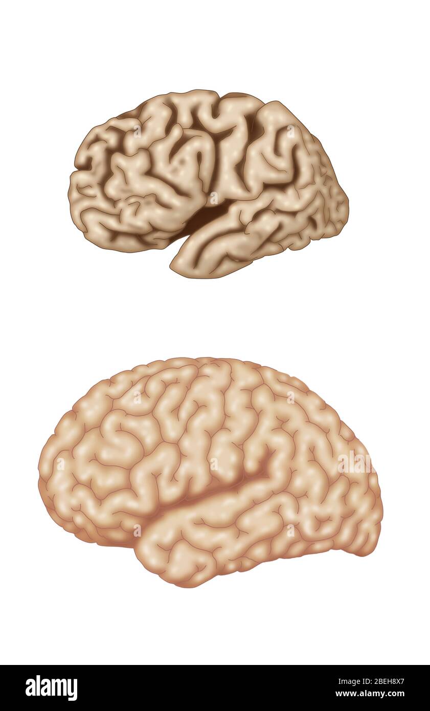 Alzheimer und normale Gehirne, Vergleich Stockfoto